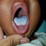 শিশুদের জিহ্বাতে সাদা প্রলেপ | ওরাল থ্রাশ (Oral Thrush) হোমিও ঔষধ