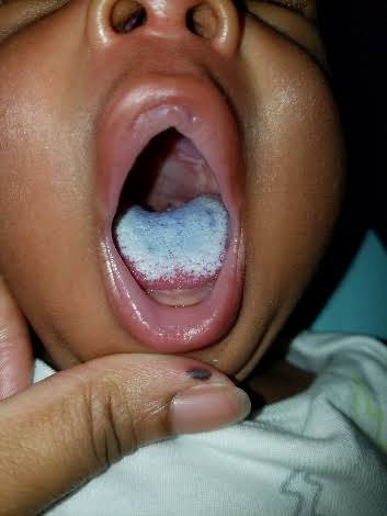 শিশুদের জিহ্বাতে সাদা প্রলেপ | ওরাল থ্রাশ (Oral Thrush) হোমিও ঔষধ